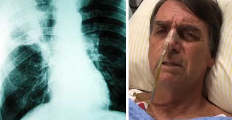 Problema de saúde em Bolsonaro é descoberto. Presidente está com pneumonia - Foto/Divulgação