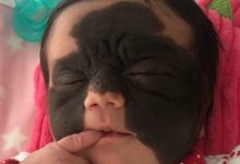 Nevo melanocítico congênito atinge criança - Foto/Divulgação