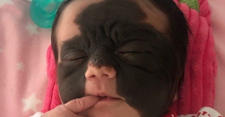 Nevo melanocítico congênito atinge criança - Foto/Divulgação